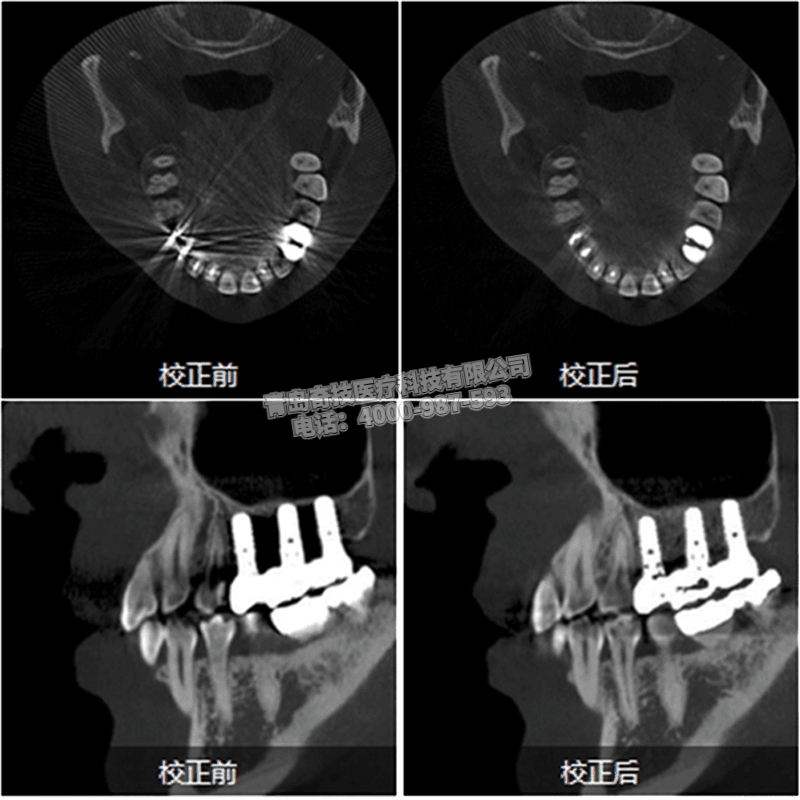 西藏口腔CBCT 全景機LARGEV國產(chǎn)朗視產(chǎn)品介紹HiRes3D