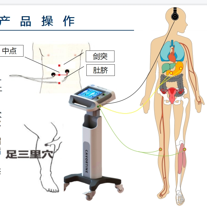 數(shù)字音樂(lè)電胃腸功能治療儀-消化內(nèi)科。重癥ICU